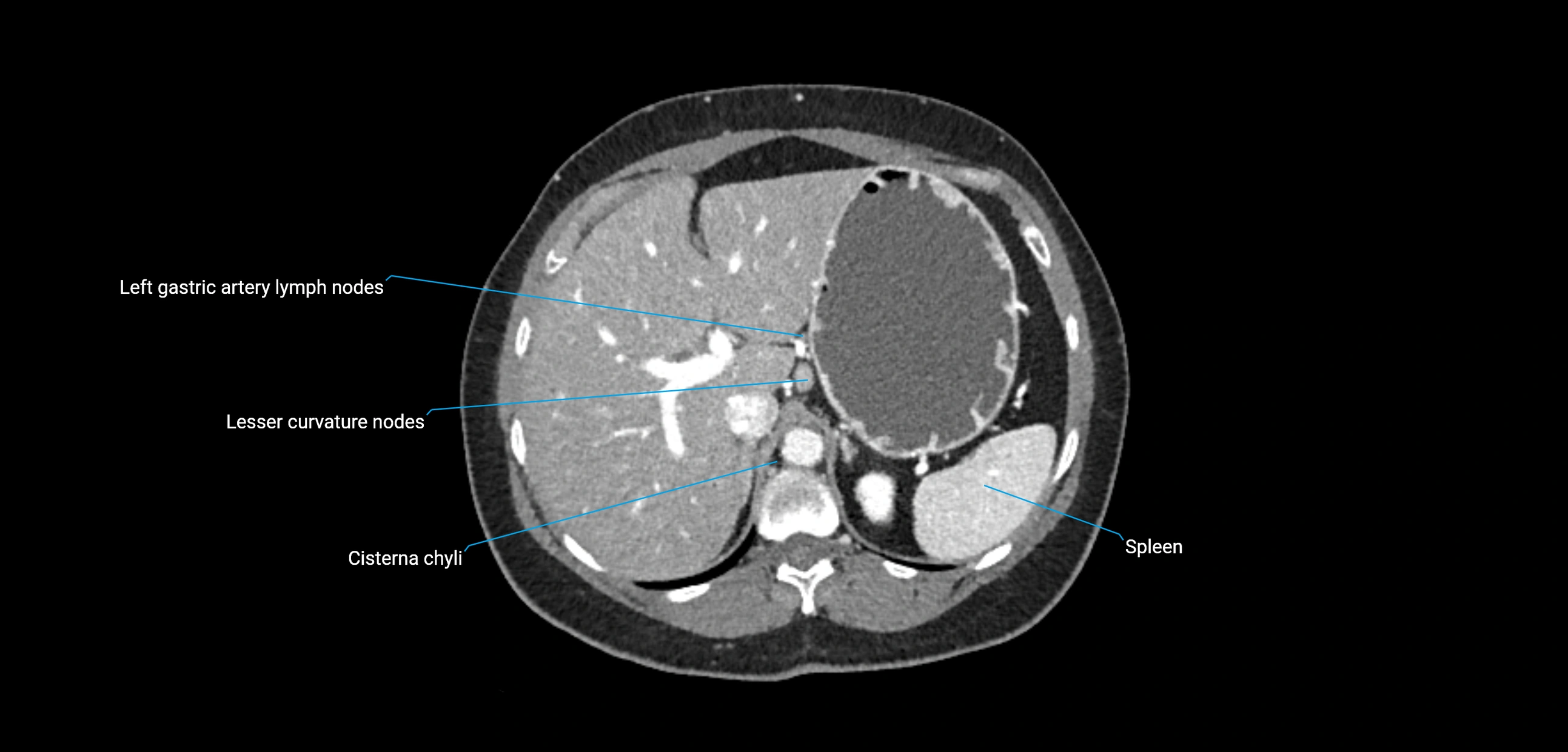 CT ct abdominal lymph nodes  axial cross sectional anatomy  enchanced radiology image -img-00002-00123.webp